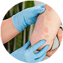 Psoriasis/Eczema